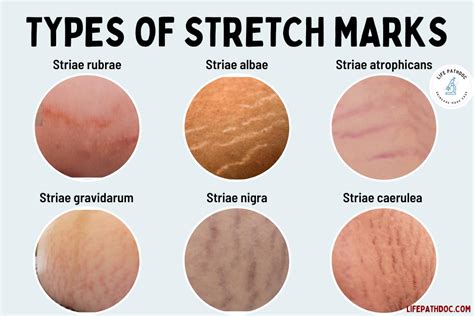 Can Guys Have Stretch Marks? Exploring the Myths and Realities of Male Skin